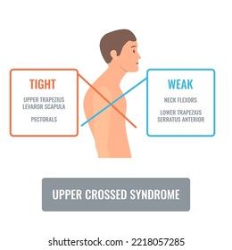 Upper crossed syndrome medical diagram. Crooked man with muscle strength imbalance. Weak and overactive muscles therapy. Incorrect spine curvature caused by bad posture. Vector illustration.