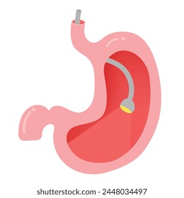 An upper endoscopy. Human's Stomach.