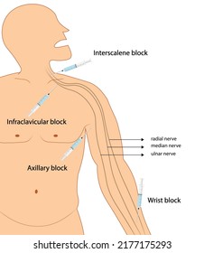 Upper extremity nerve block. Regional anesthesia ilustration. Needle placement. 