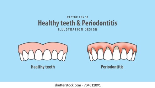 upper healthy teeth & Periodontitis illustration vector on blue background. Dental concept.