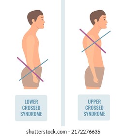 Upper and lower crossed syndrome medical diagram. Crooked man with muscle strength imbalance. Weak and overactive muscles therapy. Incorrect spine curvature caused by bad posture. Vector illustration.