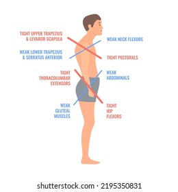 Upper and lower crossed syndrome medical diagram. Crooked man with muscle strength imbalance. Weak and overactive muscles therapy. Incorrect spine curvature caused by bad posture. Vector