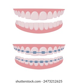 Upper and lower jaws with braces on teeth. Orthodontics and aesthetic dentistry medicine. Healthy smile. Dentistry, whitening, orthodontics. Vector