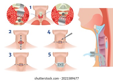 Upper and lower tracheostomy. Tracheal surgery. Execution scheme. A scalpel incision. Airway obstruction. Plastic cannula with inflatable cuff.
Нead thrown back. Medical vector illustration