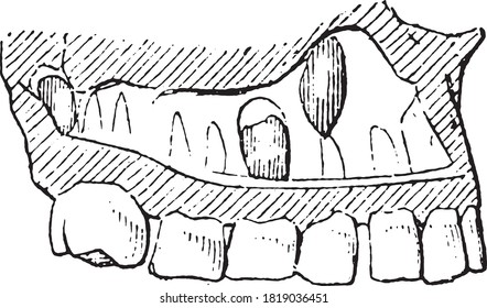 Upper maxillary dentition of a 7 year old child, From the Dictionary of Word and Things, 1888.
