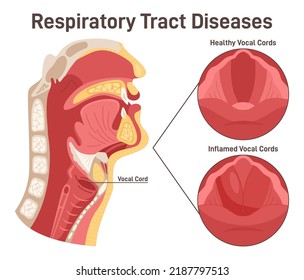 Upper respiratory tract disease. Laryngitis, inflammation of the vocal cords. Structure of the bones, muscles and tissue. Medical education poster. Flat vector illustration