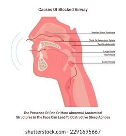 Upper respiratory tract, human nasal and oral cavity structure. Respiratory system diseases and anomalies causing airway blockage. Flat vector illustration