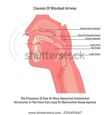 Upper respiratory tract, human nasal and oral cavity structure. Respiratory system diseases and anomalies causing airway blockage. Flat vector illustration