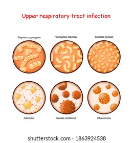 Upper respiratory tract infection. Close-up of causative agents of tonsillitis, nasal obstruction, sore throat, pharyngitis, laryngitis, and sinusitis: Viruses and bacteria