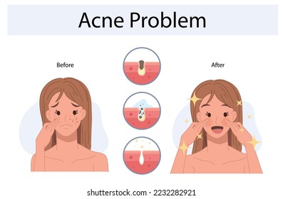 Verärgerte Frau mit Gesichtshautproblemen. Infographie der Akne-Krankheit und der Behandlungsstadien. Vor und nach. Vektorgrafik.