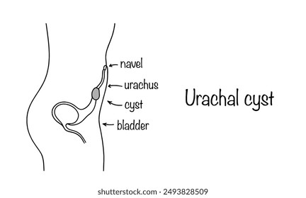 Urachal cyst. A congenital pathology in which the embryonic urinary duct does not heal. Pathological connection of the bladder with the navel and the presence of a cyst inside. Rare medical disease.