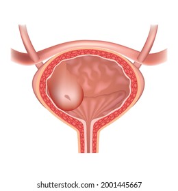 Ureterocele. The Structure Of The Human Genitourinary System. Vesicular Compartment. Hernia In The Urinary Bladder. Vector Illustration.
