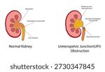 Ureteropelvic Junction (UPJ) obstruction vector illustration