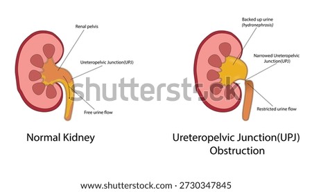 Ureteropelvic Junction (UPJ) obstruction vector illustration