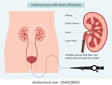 Ureteroscopia com litotripsia a laser é usada para quebrar pedras nos rins. Durante este procedimento, um feixe de laser é aplicado diretamente na pedra para quebrá-la em pequenos pedaços e passar facilmente.