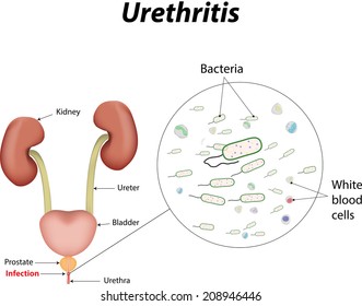Gyertyák urethritis és prosztatitis
