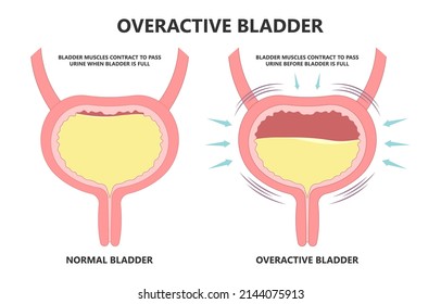 Urge Pass Urine Of Pelvic Floor Muscle Frequently Bed Wetting Toilet Urination Older Nerve Brain Spasm Tract Tumor Cancer Stroke Stress Atonic Benign Lower Often Leak Anuria Neural Cystitis Cord