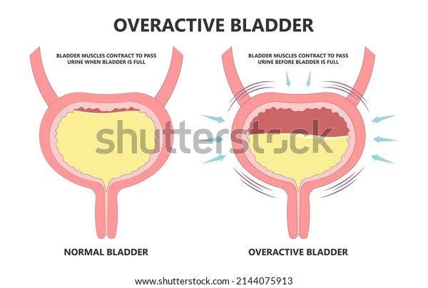 urge pass urine of pelvic floor muscle frequently\
Bed wetting toilet urination older nerve brain spasm tract tumor\
cancer stroke stress atonic Benign Lower Often leak anuria Neural\
Cystitis cord
