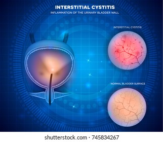 Urinary bladder surface examination with Cystoscope closeup of healthy lining and unhealthy cystitis on an abstract blue background