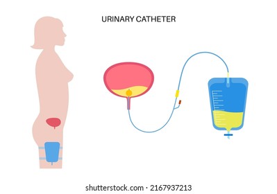 Urinary catheter in the female body. Empty bladder and collect urine in leg bag. Tube from internal organs to urethra. Urethral drainage equipment. Difficulty peeing naturally flat vector illustration