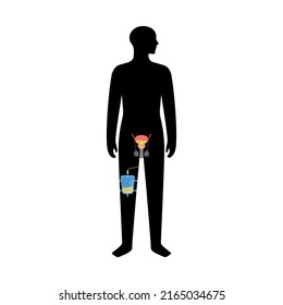 Urinary Catheter In Male Body. Empty Bladder And Collect Urine In A Leg Bag. Tube From Urethra To Internal Organ. Urethral Drainage Equipment. Prostate Enlargement, Difficulty Peeing Naturally Vector.