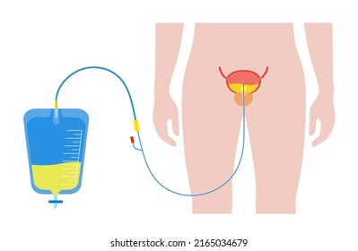 Urinary catheter in male body. Empty bladder and collect urine in a leg bag. Tube from urethra to internal organ. Urethral drainage equipment. Prostate enlargement, difficulty peeing naturally vector.