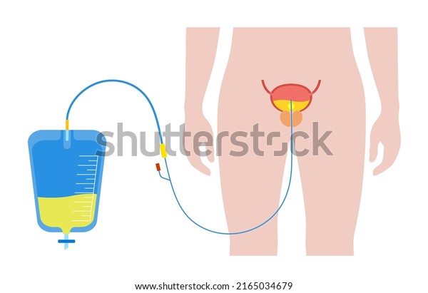 Urinary Catheter Male Body Empty Bladder Stock Vector Royalty Free Shutterstock