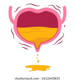Urinary incontinence. Overactive bladder illustration.