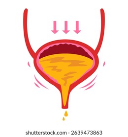 Urinary Incontinence. Overactive bladder illustration. Bladder disease