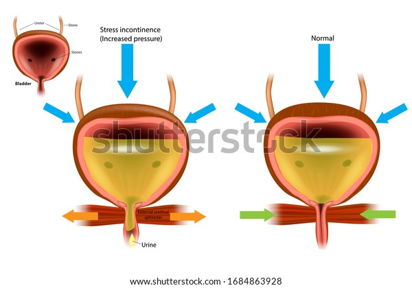 Urinary Incontinence Ui Known Involuntary Urination Stock Vector ...