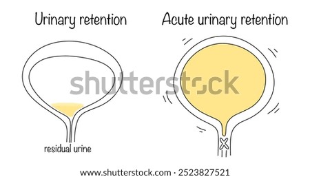 Urinary retention. A condition in which some urine remains in the bladder after urination. Acute urinary retention. A condition when the patient is unable to empty a full bladder on his own. Vector
