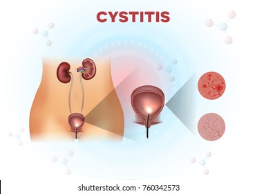 Urinary system anatomy, urinary bladder examination, normal and unhealthy lining with cystitis on a light abstract scientific background