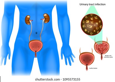 104 Inflamed Urethra Urinary Tract Images, Stock Photos & Vectors 