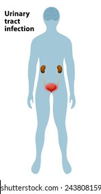 Urinary Tract Infection. Cystitis. Bladder highlighted on the silhouette of a men