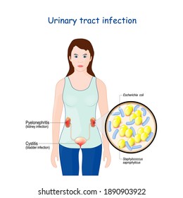 Urinary tract infection. cystitis, and pyelonephritis. Woman with kidneys and bladder. Close-up of bacteria that caused this disease: Staphylococcus saprophyticus, and Escherichia coli (E. coli)