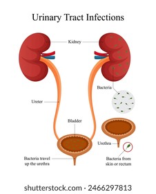 Diseño de un diagrama de infección del tracto urinario (ITU) para uso médico