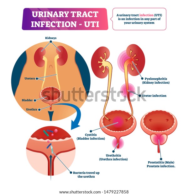 urethritis cystitis pyelonephritis