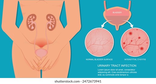 La infección del tracto urinario es un tipo muy común de infección en el aparato urinario. Puede afectar cualquier parte del aparato urinario. Bacterias causantes de infección del tracto urinario, Ilustración vectorial.