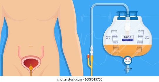 Urine bag medical treatment drainage bladder rubber flexible body infection bacteria output measure tract toilet leg relieve cancer device calculi vesical problem anatomy sterile surgical urethra
