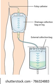 Urine collection bag placed on the thigh with external collection system