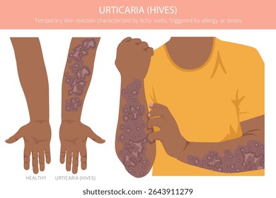 Urticária. Urticária. Doenças da pele. Design de infográfico médico. Ilustração vetorial