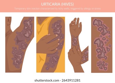 Urticária. Urticária. Doenças da pele. Design de infográfico médico. Ilustração vetorial