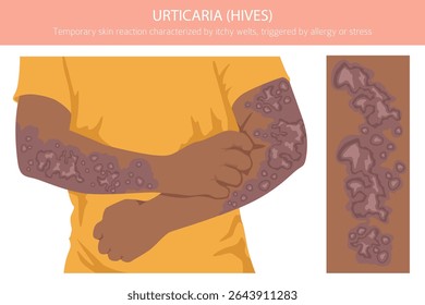 Urticária. Urticária. Doenças da pele. Design de infográfico médico. Ilustração vetorial