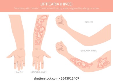 Urticária. Urticária. Doenças da pele. Design de infográfico médico. Ilustração vetorial