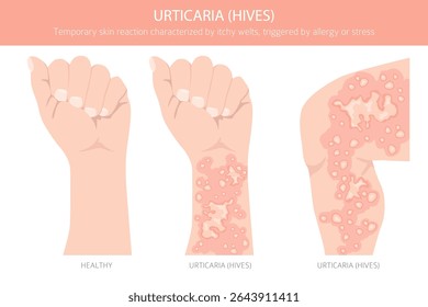Urticária. Urticária. Doenças da pele. Design de infográfico médico. Ilustração vetorial