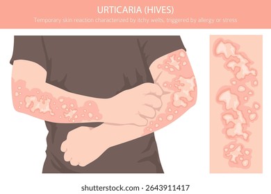 Urticária. Urticária. Doenças da pele. Design de infográfico médico. Ilustração vetorial