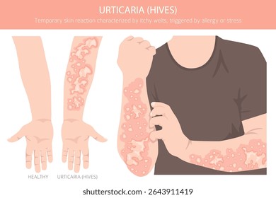 Urticária. Urticária. Doenças da pele. Design de infográfico médico. Ilustração vetorial