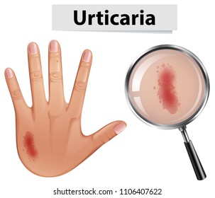 Urticaria magnified on hand illustration