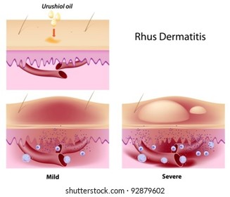 Urushiol Oil Induced Contact Dermatitis