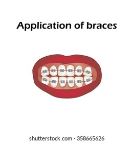 The use of braces. Crooked teeth. Orthodontics. Infographics. Vector illustration on isolated background.